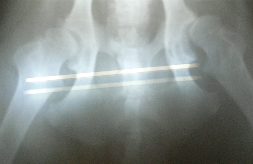 2010年6月第一次的X光片.JPG